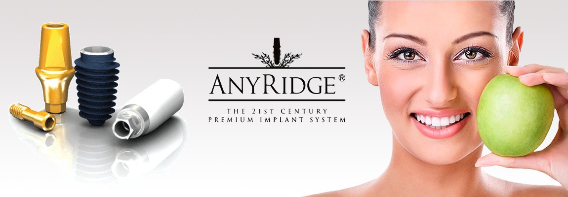 Имплантаты AnyRidge 