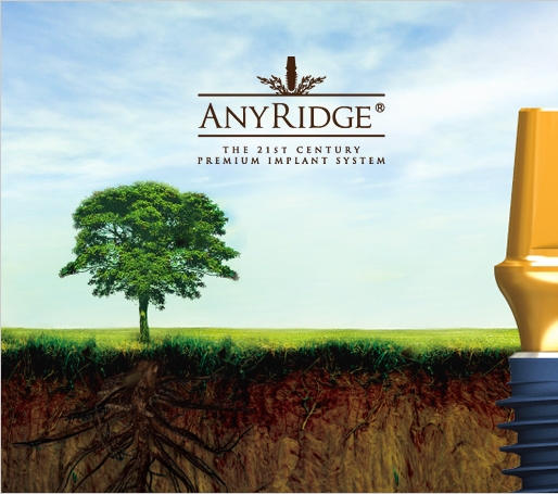 Имплантаты AnyRidge