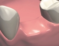 Этапы имплантации зубов - подготовка