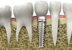 Имплантация зубов или протезирование зубов